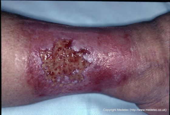 Leg Ulcer